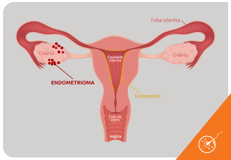 Vamos falar de Endometriose?